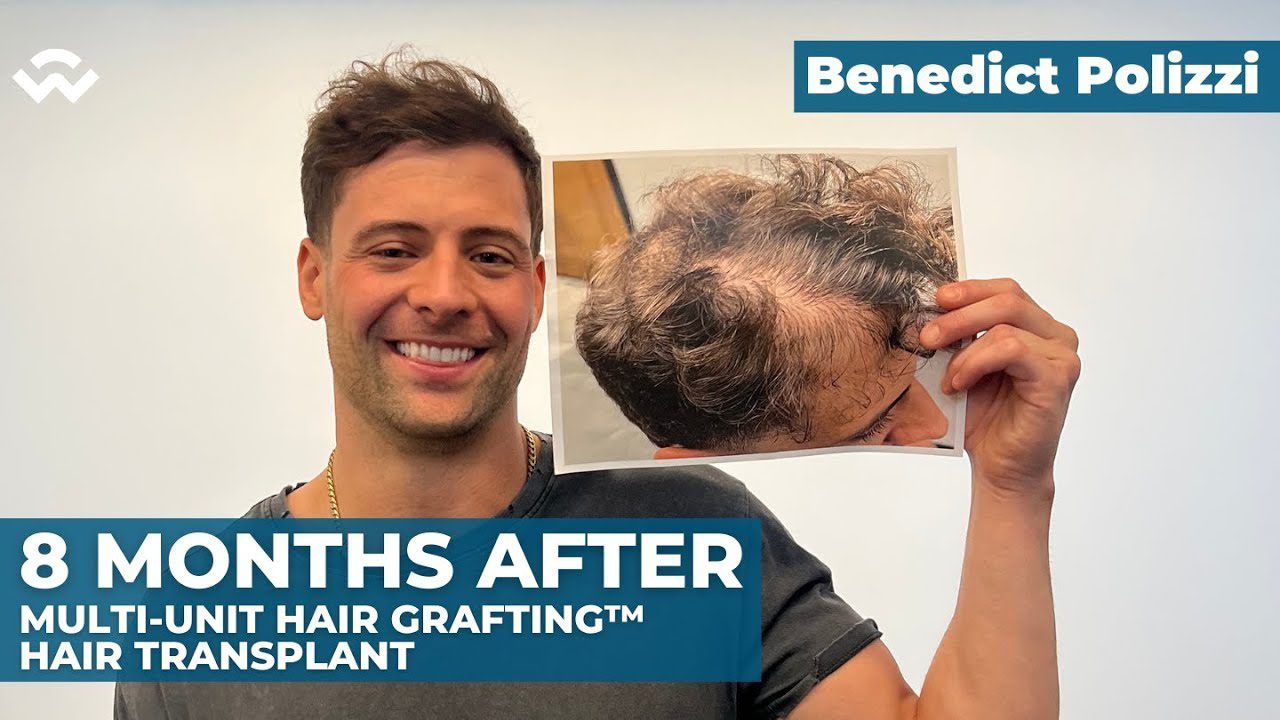 Benedict Polizzi - 8 Months After Multi-Unit Hair Grafting™ Hair Transplant