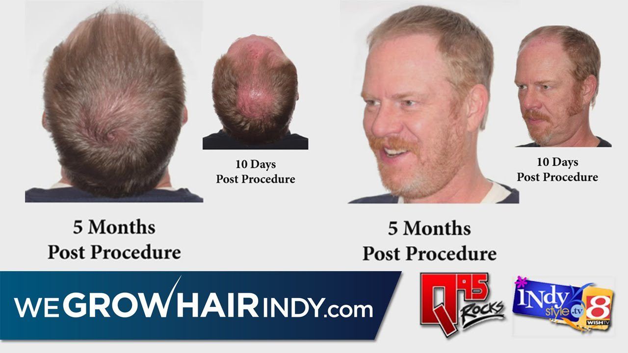 5 Mo. Hair Transplant Results - Q95