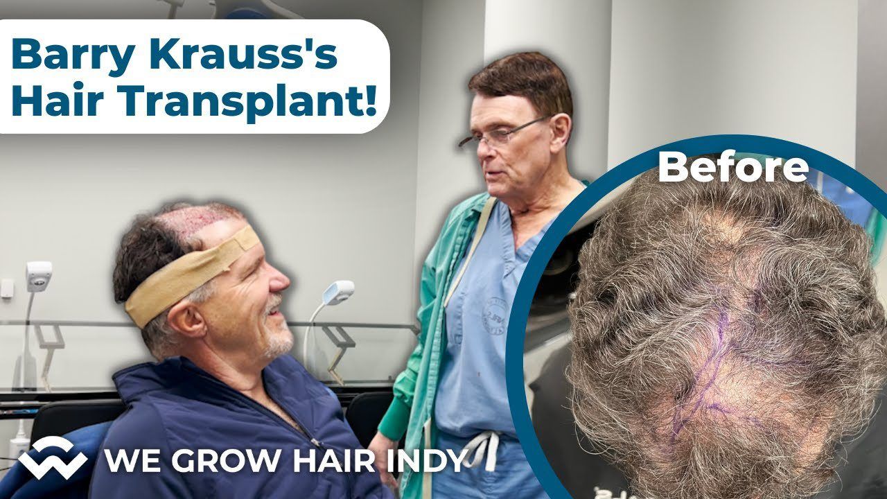 Amazing Hair Transplant Results - Greg