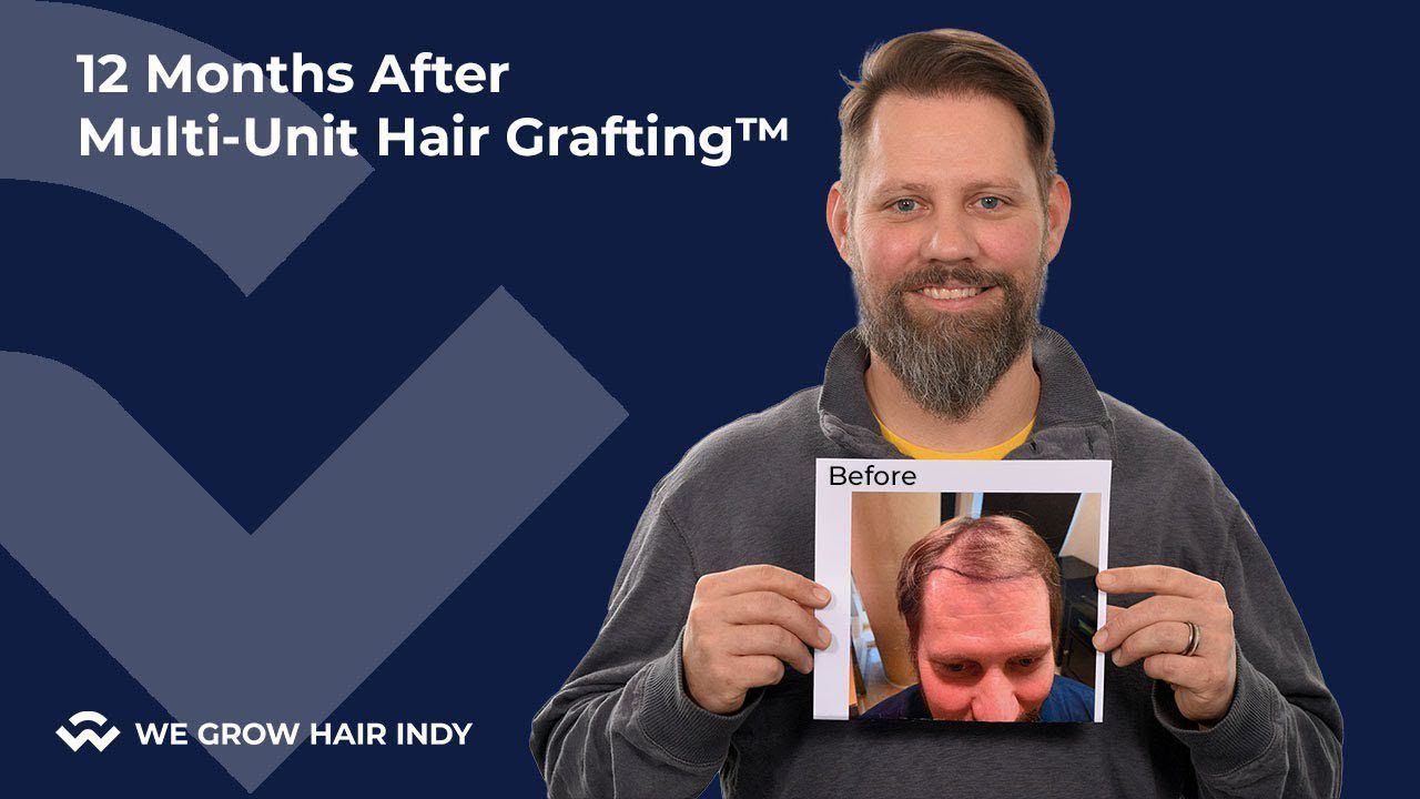 Hair Transplant Results I 12 Months After Hair Transplant I Seth