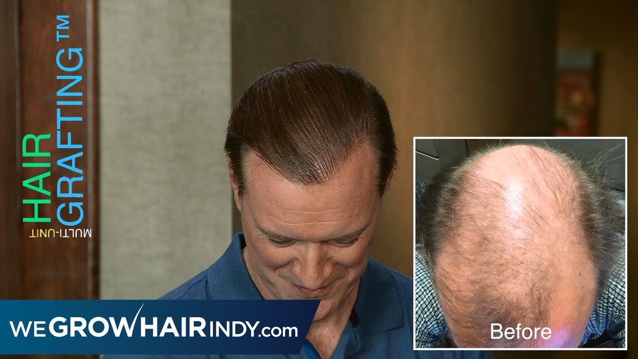 Natural Hair Transplant - Advanced Hair Loss 2 Procedures