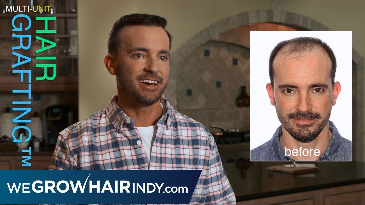 Permanent Hair Loss Solution - Multi-Unit Hair Grafting™