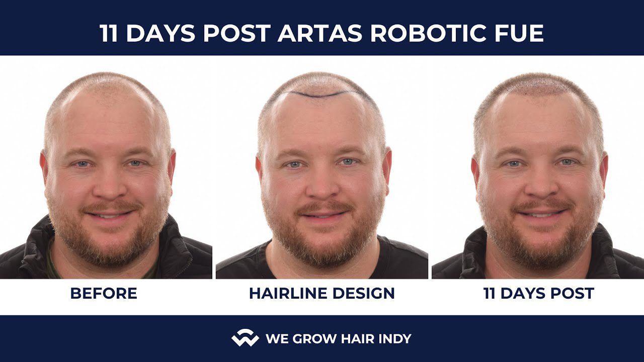 ARTAS Robotic FUE - Josh 11 Days Post Procedure