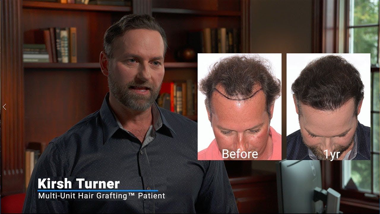 Multi-Unit Hair Grafting™ Hair Transplant Results – WeGrowHairIndy Client Kirsh