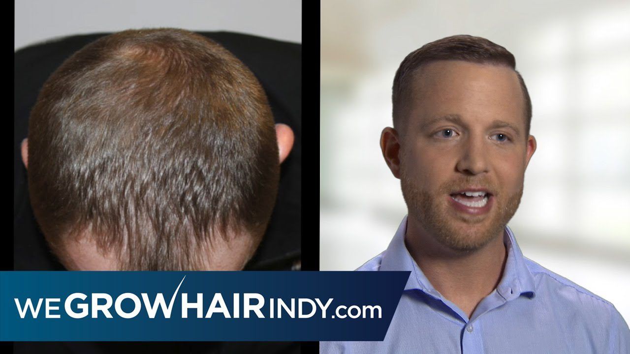 Hair Transplant Q&A - Jonathan