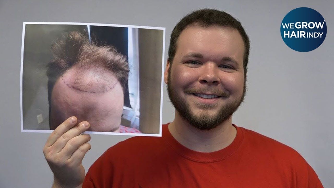 12 Month Hair Transplant Results - Darrin Danhauer