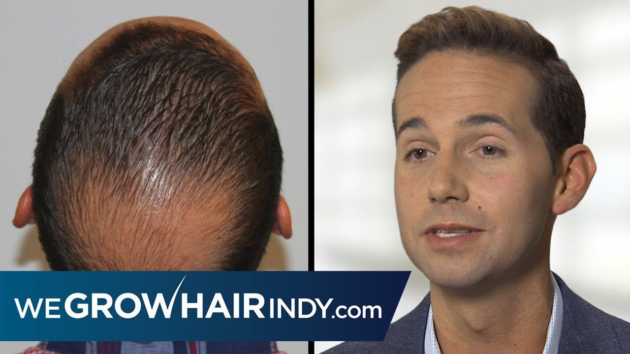 Crown Hair Transplant Results - Chris