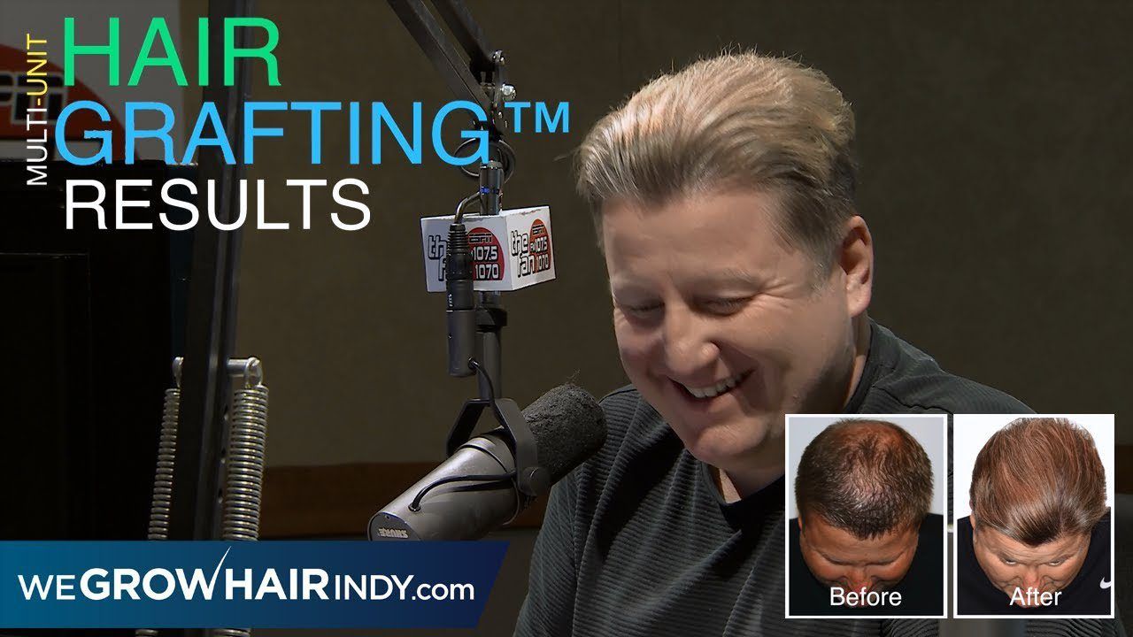 Hair Transplant Results - JMV 1070 The Fan