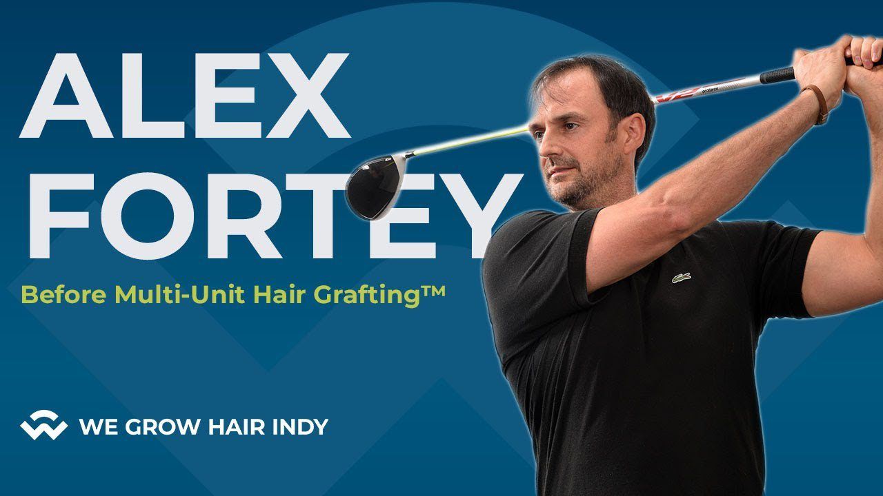 Alex Fortey from The Art of Simple Golf is Getting his Hair Transplant I WGHI VIP I Alex Fortey