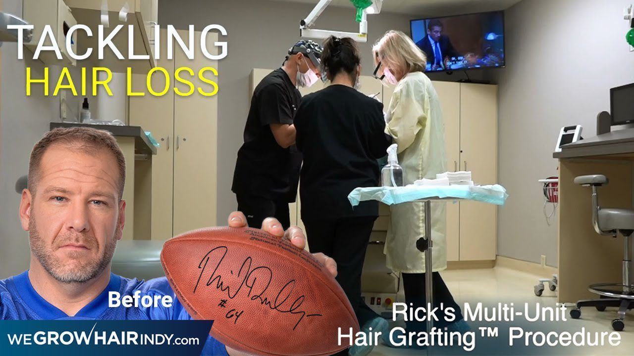 Rick DeMulling - Hair Transplant Day of Procedure (Multi-Unit Hair Grafting™)