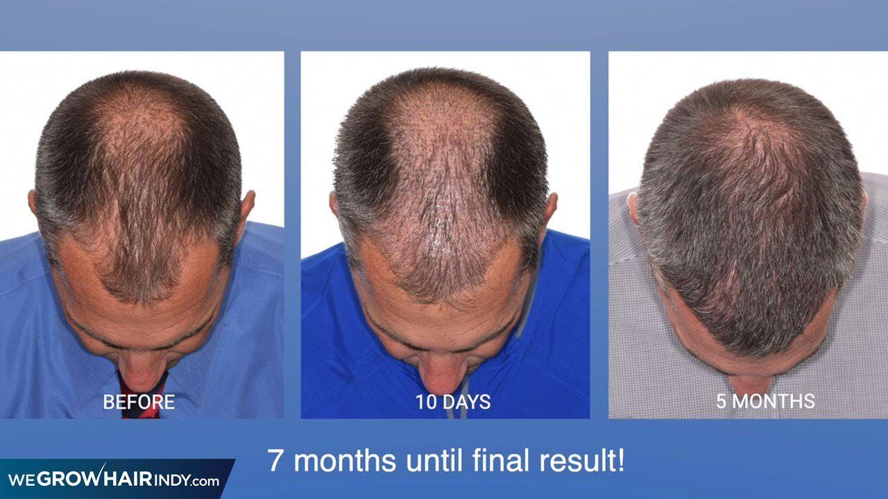 Basketball Coach Hair Transplant - Multi-Unit Hair Grafting™