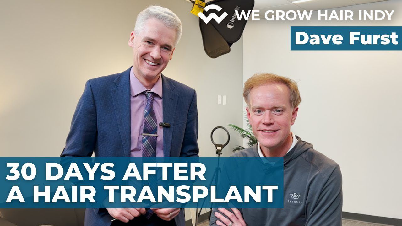 Multi-Unit Hair Grafting™ Hair Transplant - 30 Days After Dave Furst