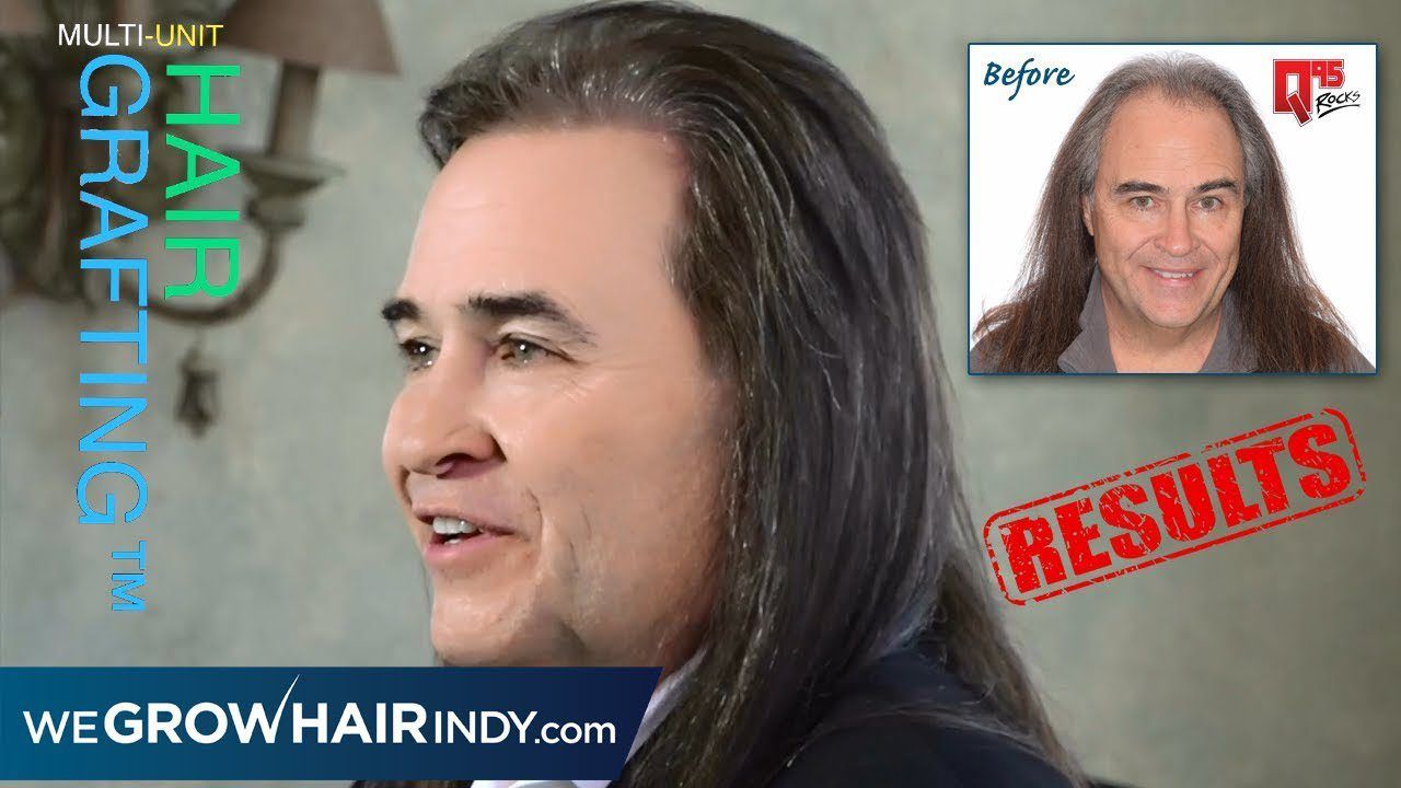 Hair Transplant Before & After | Don Stuck Q95