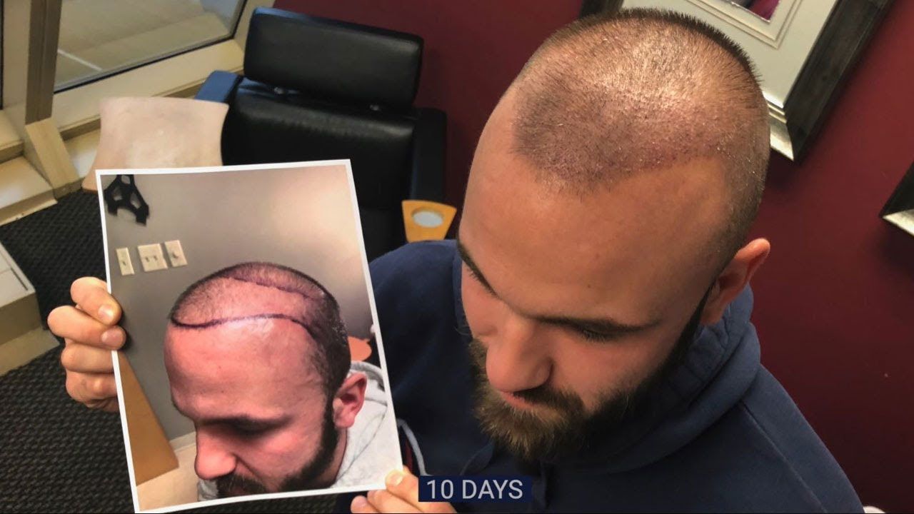 FUE Robotic Hair Transplant - 10 Days After