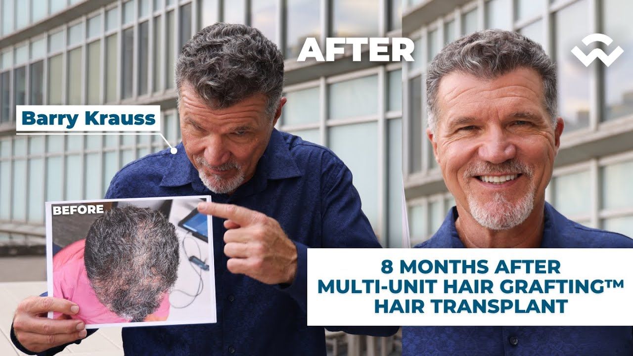 8 Months After Multi-Unit Hair Grafting™ Hair Transplant - #1 Draft Pick Barry Krauss