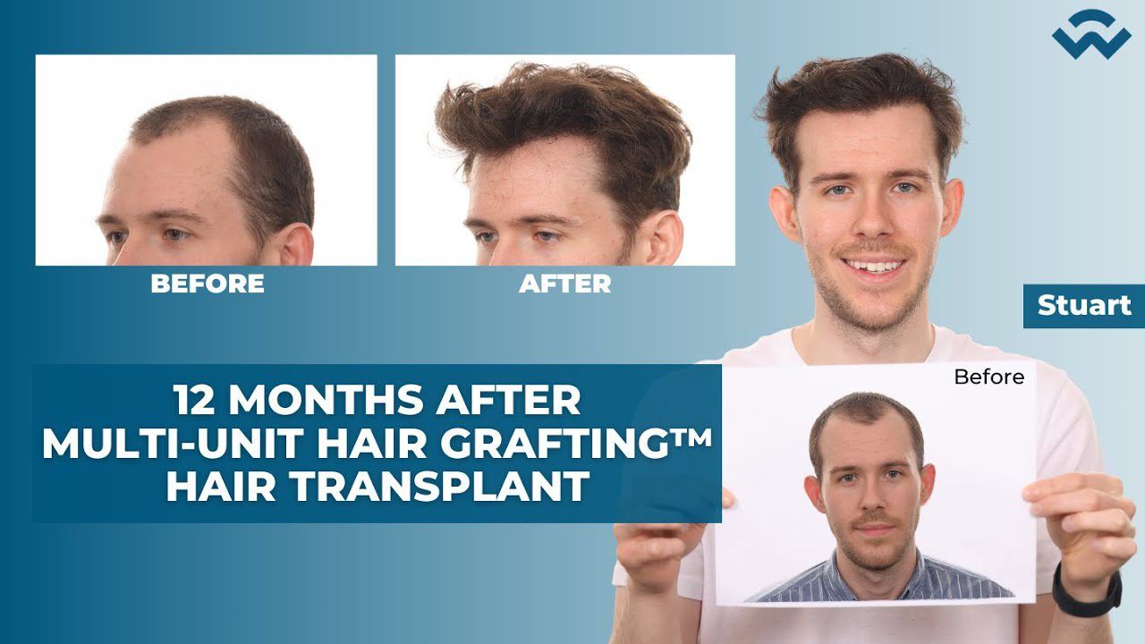 One year after Multi-Unit Hair Grafting™ Hair Transplant! Stuart