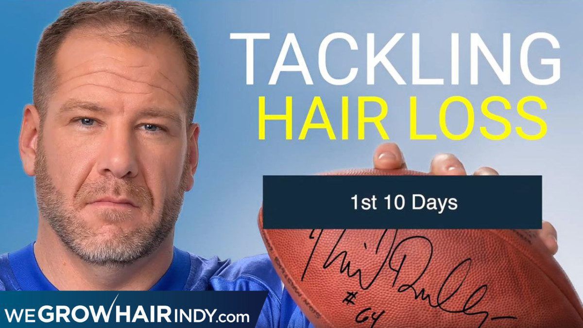 Rick DeMulling 10 Days After Multi-Unit Hair Grafting™ Hair Transplant Procedure