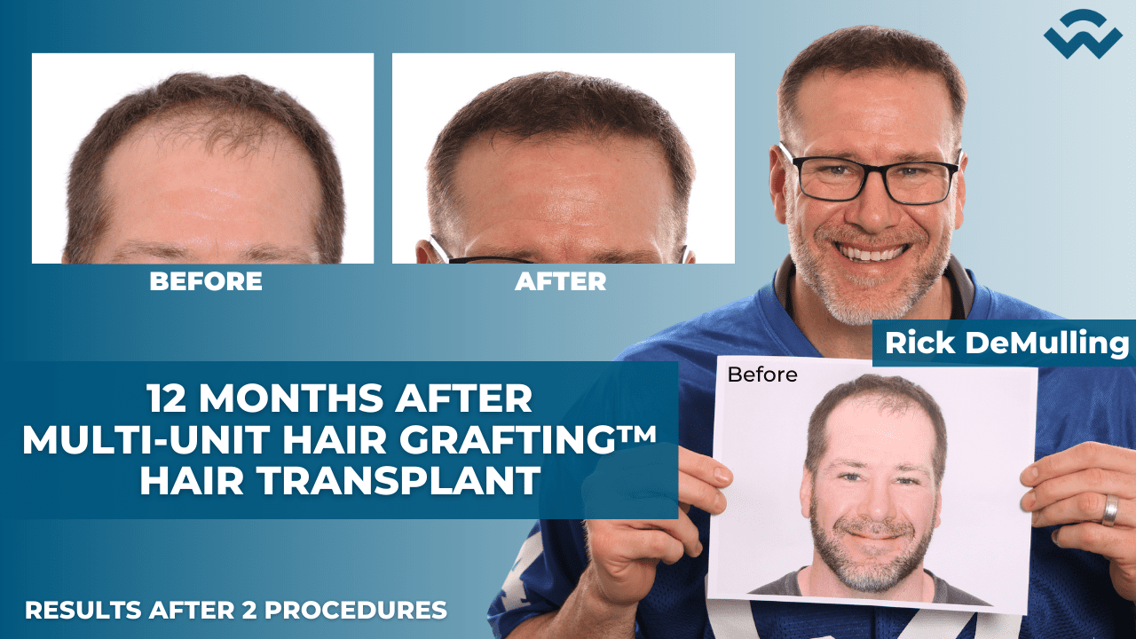 Rick DeMulling | Second Hair Transplant Procedure Results