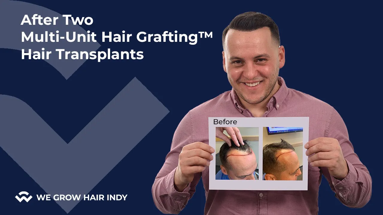 Why Get a Second Hair Transplant?