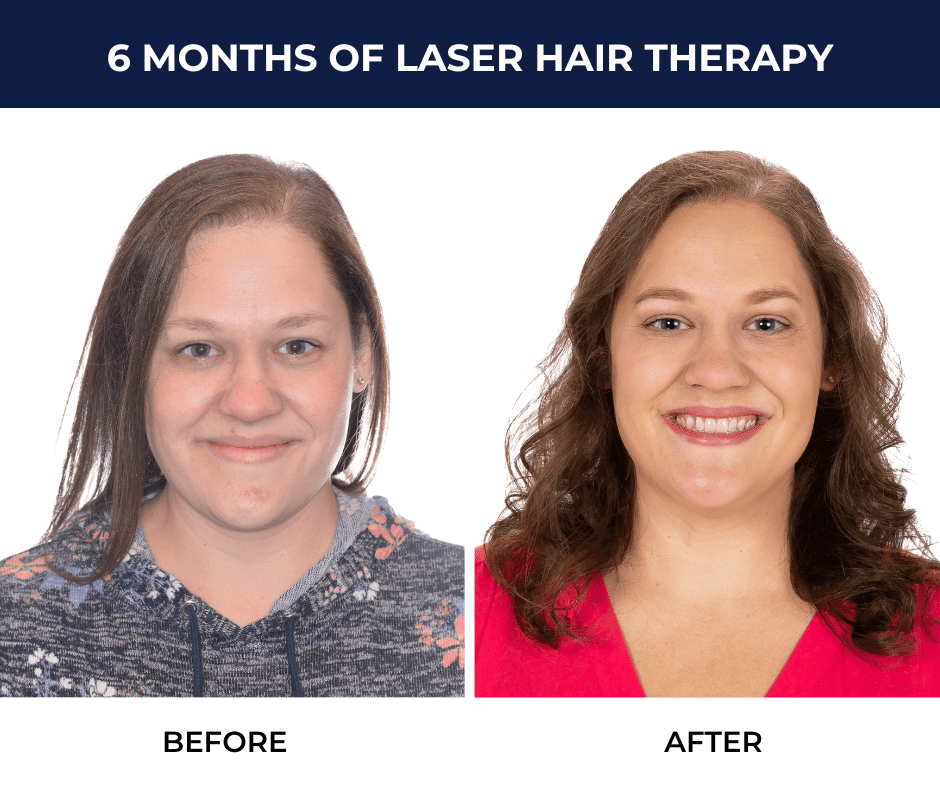 Regrow Your Postpartum Hair Loss with Laser Hair Therapy