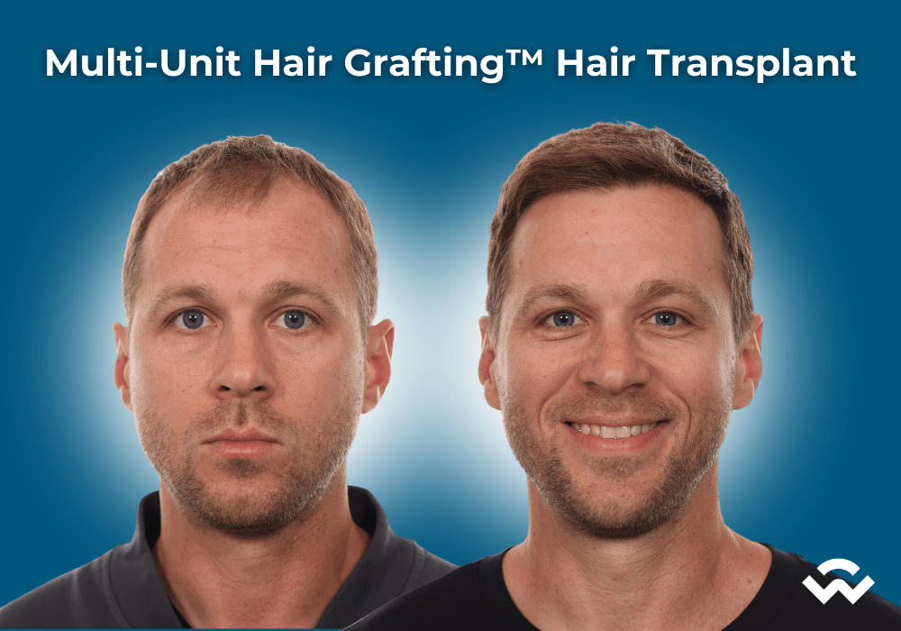 Multi-Unit Hair Grafting™ Hair Transplant Procedure