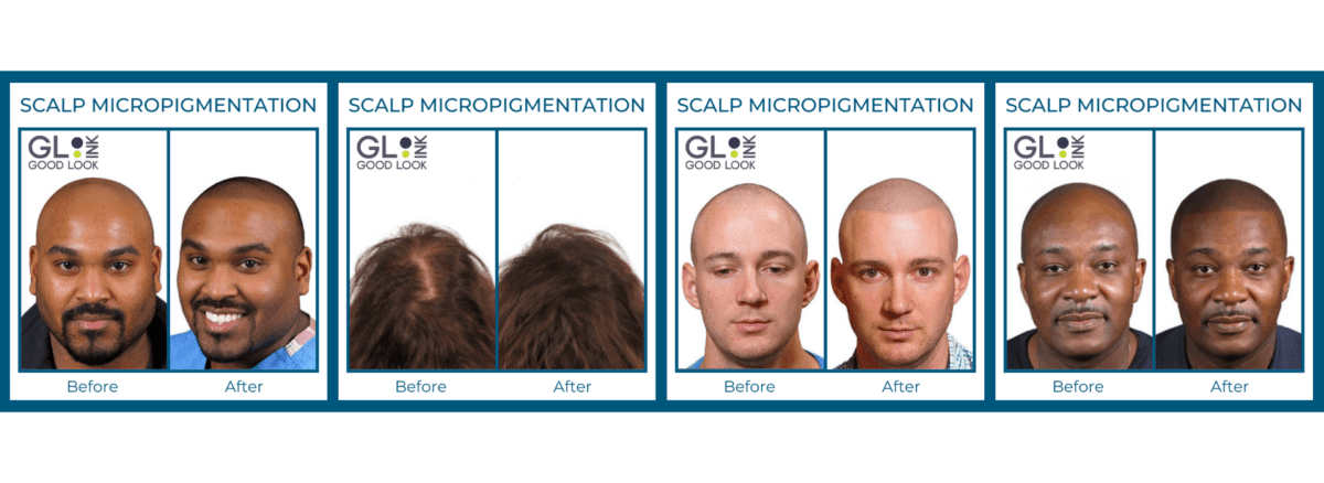 What is Scalp Micropigmentation?