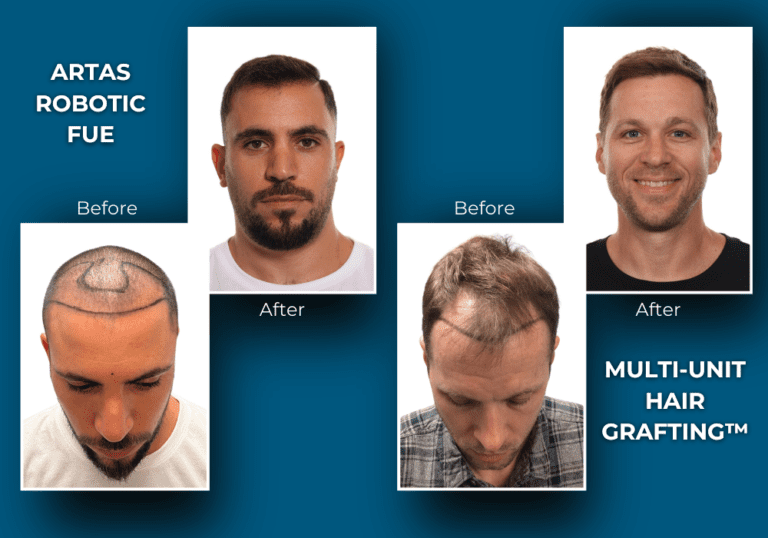 What is a Hair Transplant?