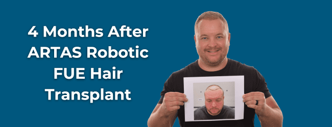 What is a Hair Transplant?