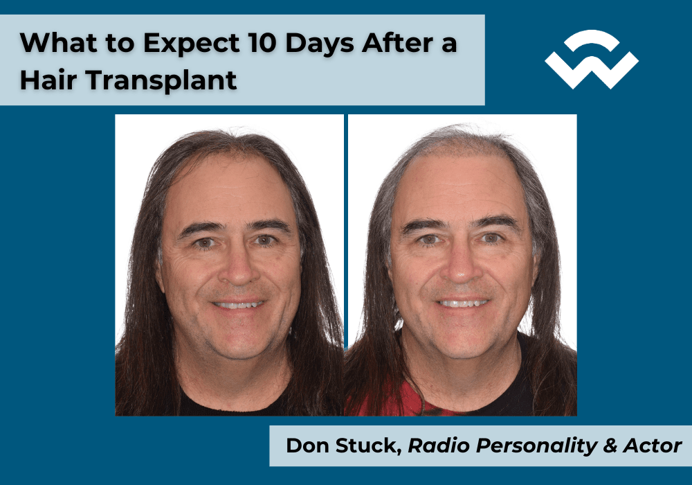 What to Expect 10 Days After Hair a Transplant Procedure