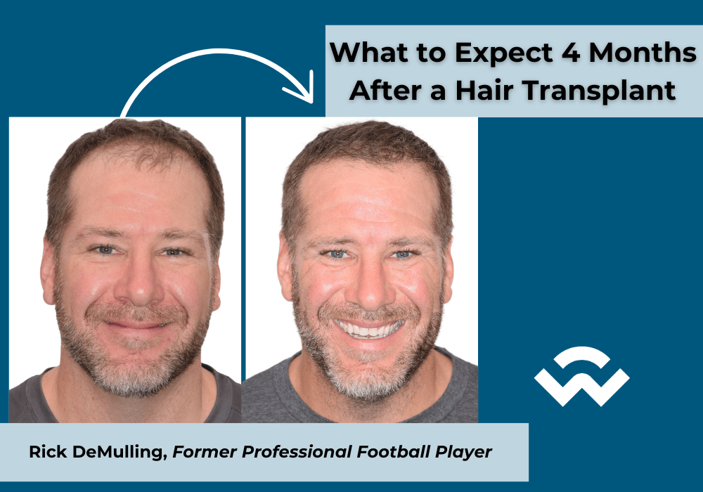 What to Expect 4 Months After a Hair Transplant