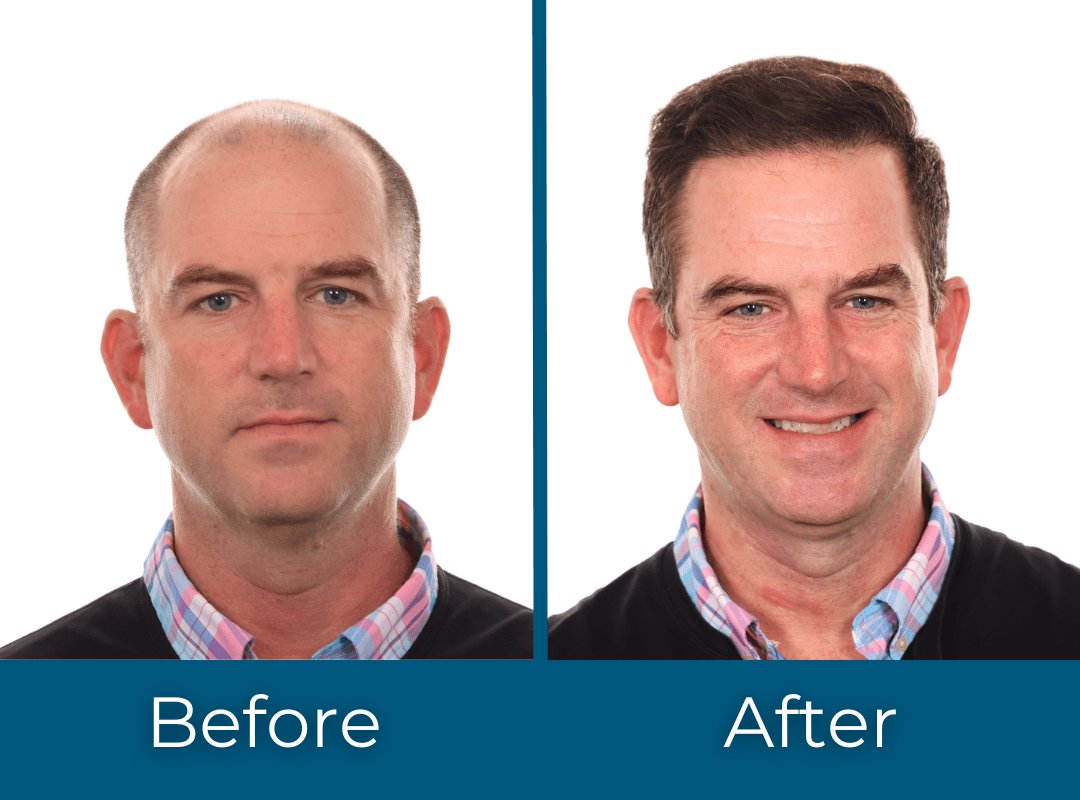 Before and After Hair Transplant