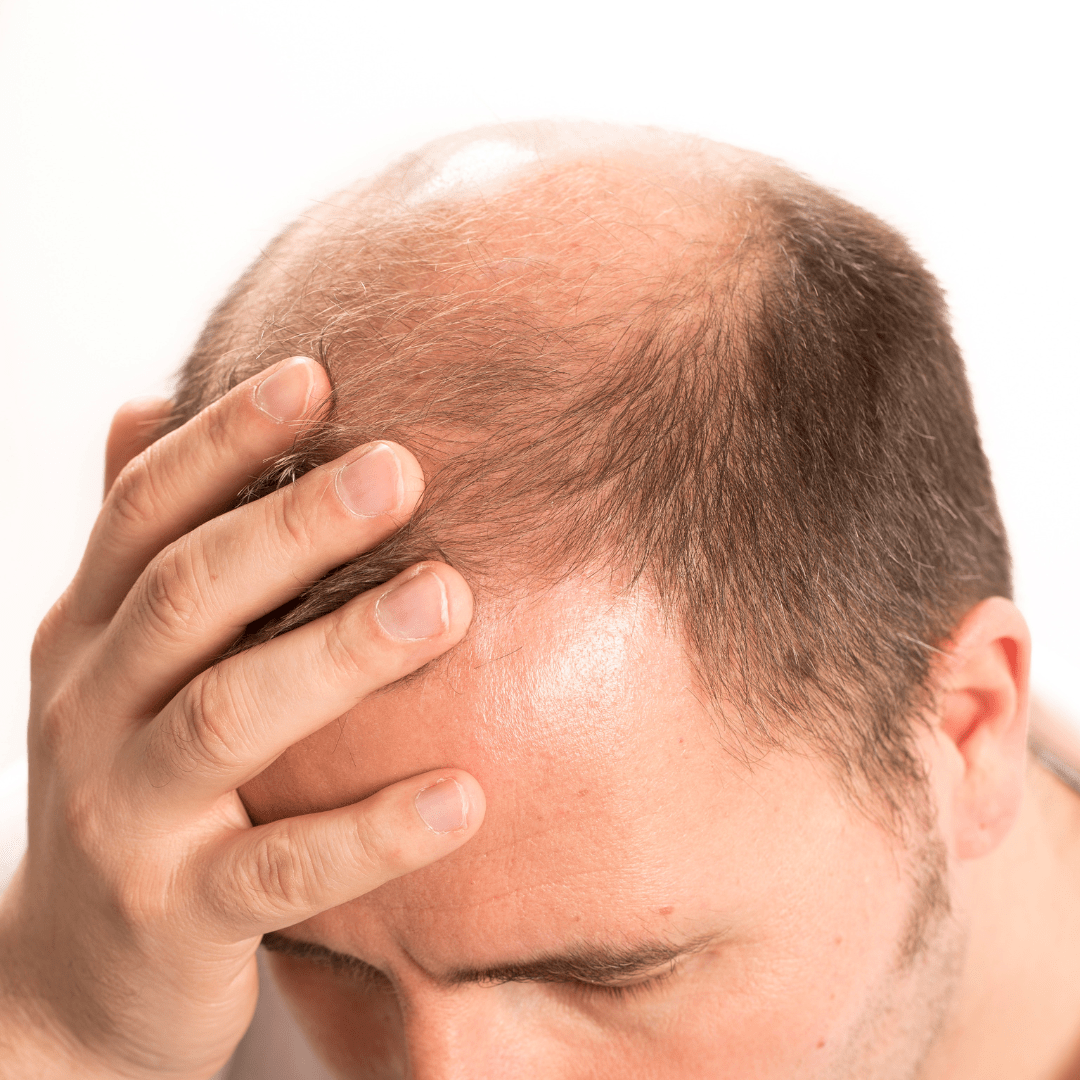 Causes of mens hair loss