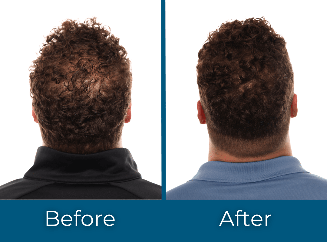 Enhanced Plasma Therapy Treatment for men Results