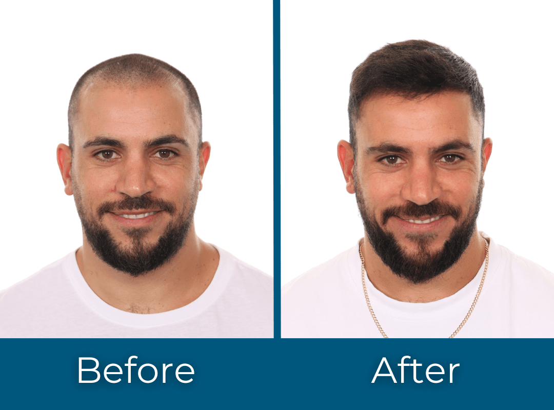 Hair Transplant Before and After Men