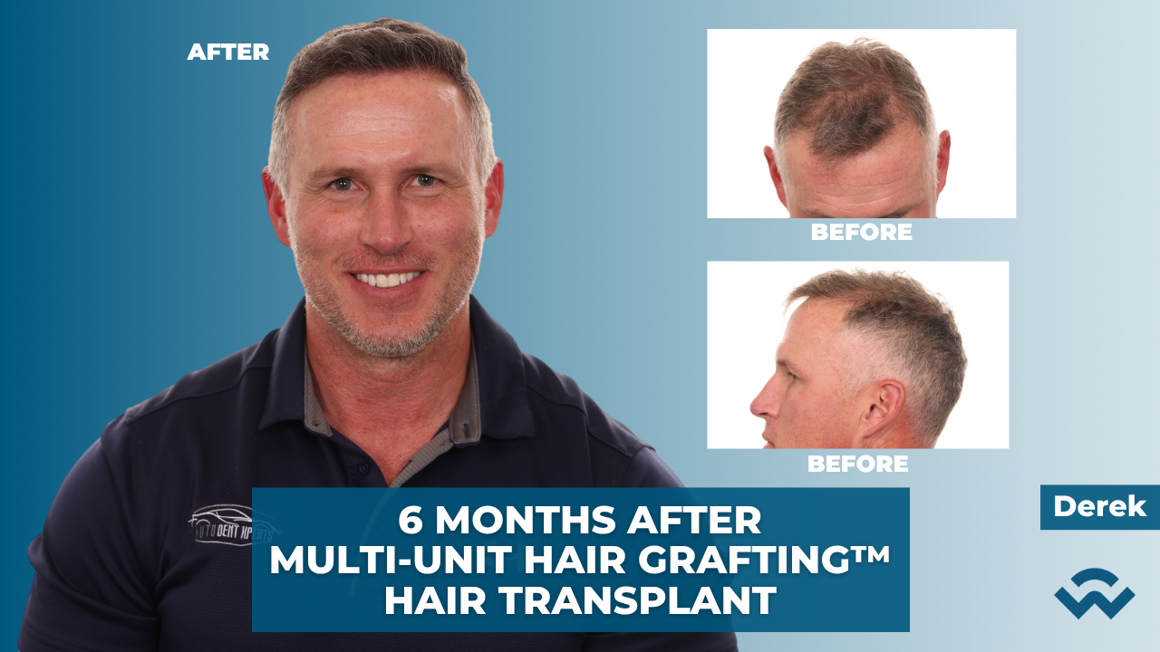 6 months after a hair transplant