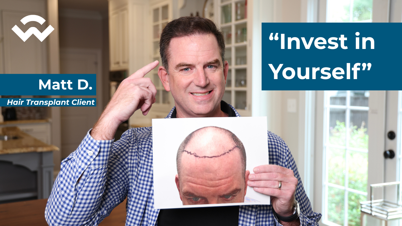 man pointing to his new hairline while holding his before picture to show his hair loss