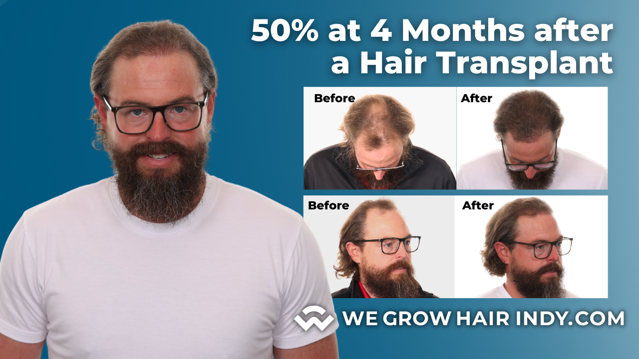 hair transplant results 4 months after a hair transplant