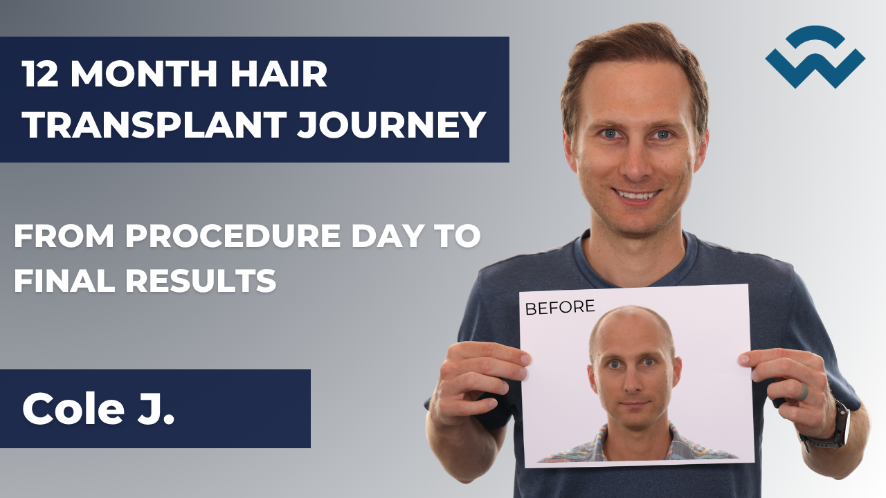 youtube thumbnail showing man holding his before picture from before his hair transplant to show his results