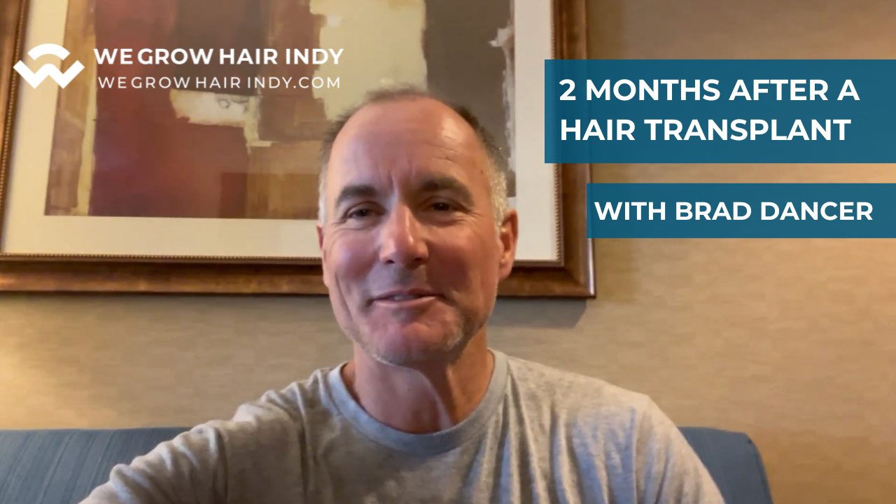 brad dancer selfie 2 months after his hair transplant