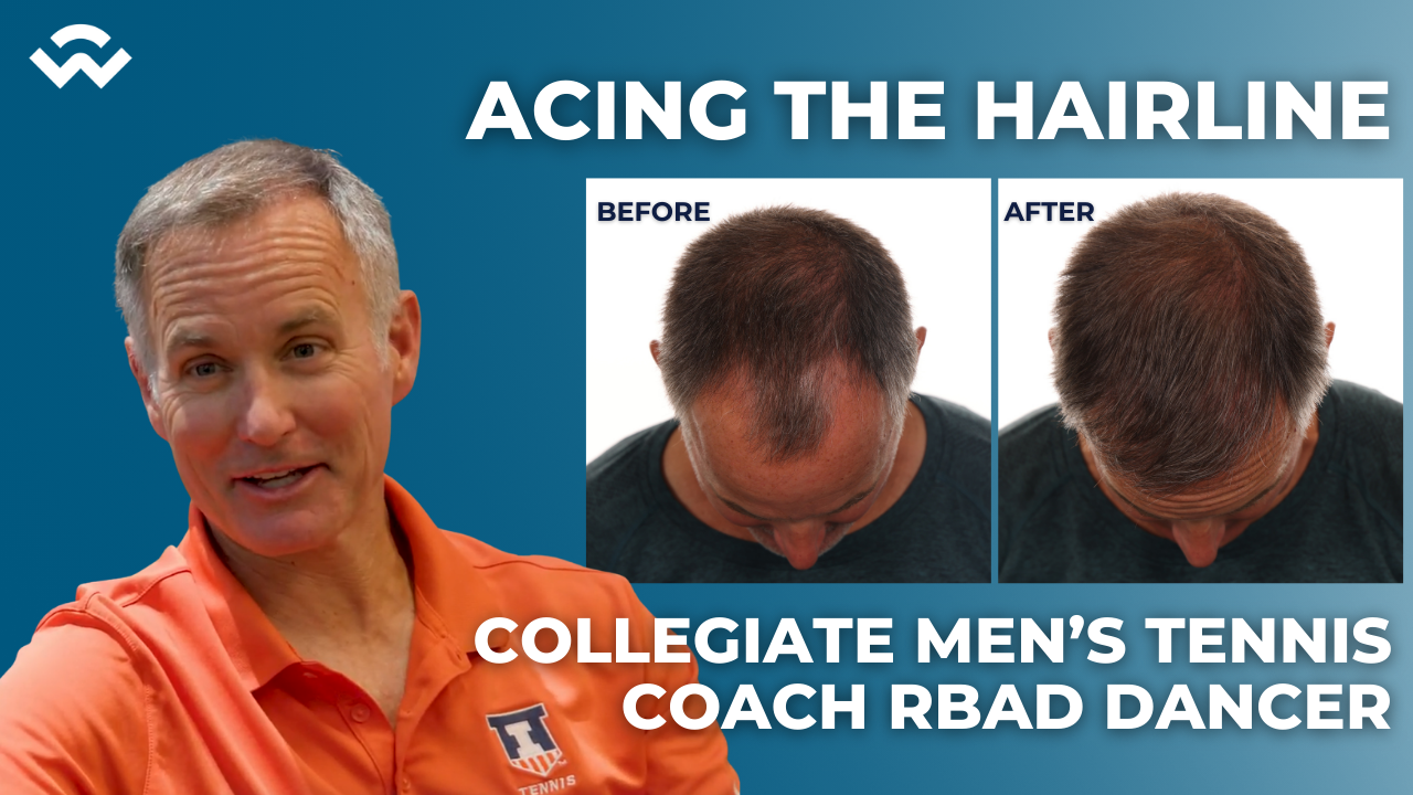 Brad Dancer final hair tranpslant results