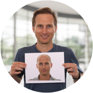 hair transplant results