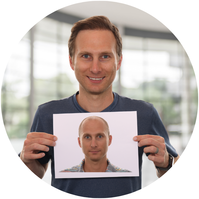 hair transplant results