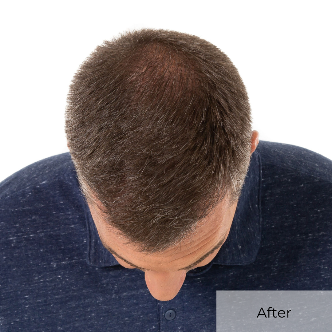 After We Grow Hair Indy Hair Transplant