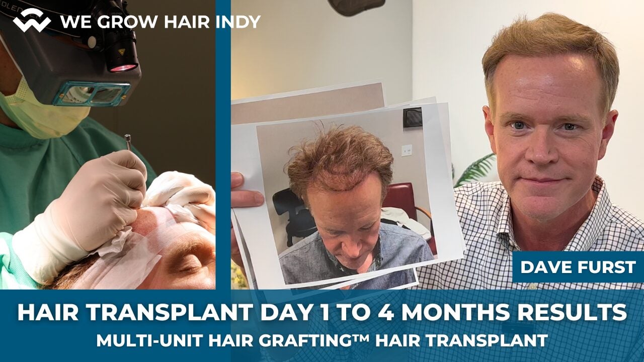 1 to 4 Months After a Hair Transplant