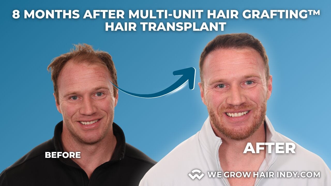 8 Month Hair Transplant Results - We Grow Hair Indy
