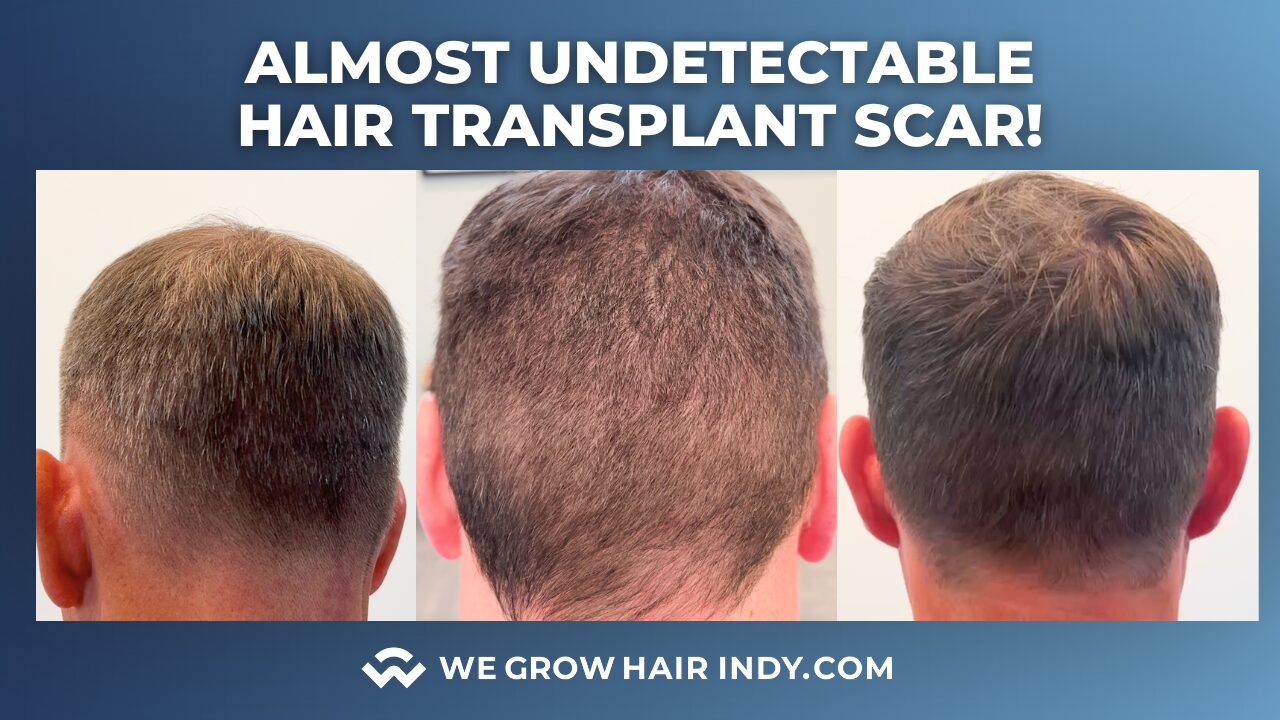 Almost Undetectable Hair Transplant Scar at We Grow Hair Indy