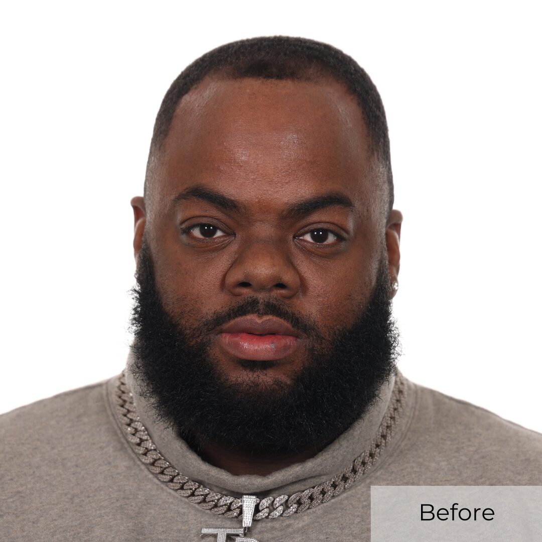 christopher mcfarland before hair transplant
