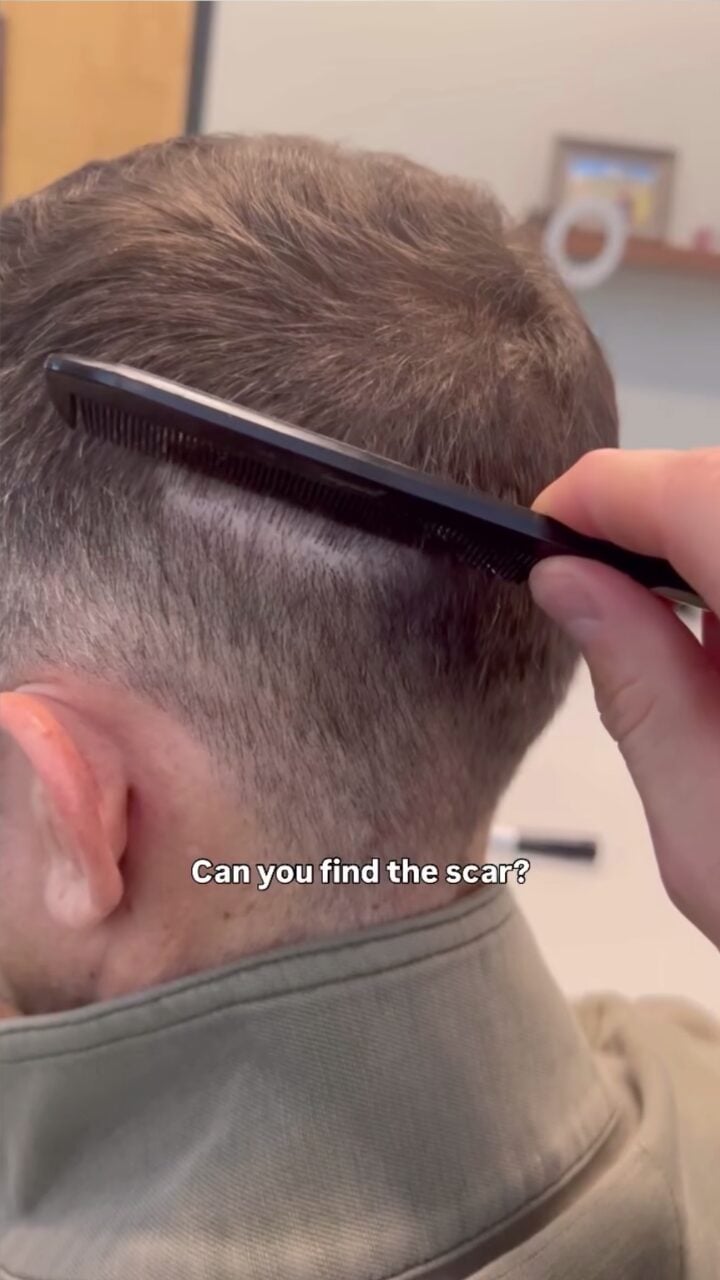 Nearly impossibe to find scar from hair transplant