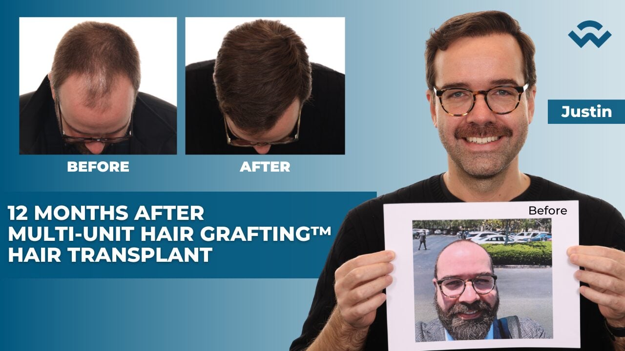 Incredible 1-Year Hair Transplant Transformation: Justin&rsquo;s Story | Multi-Unit Hair Grafting&trade;