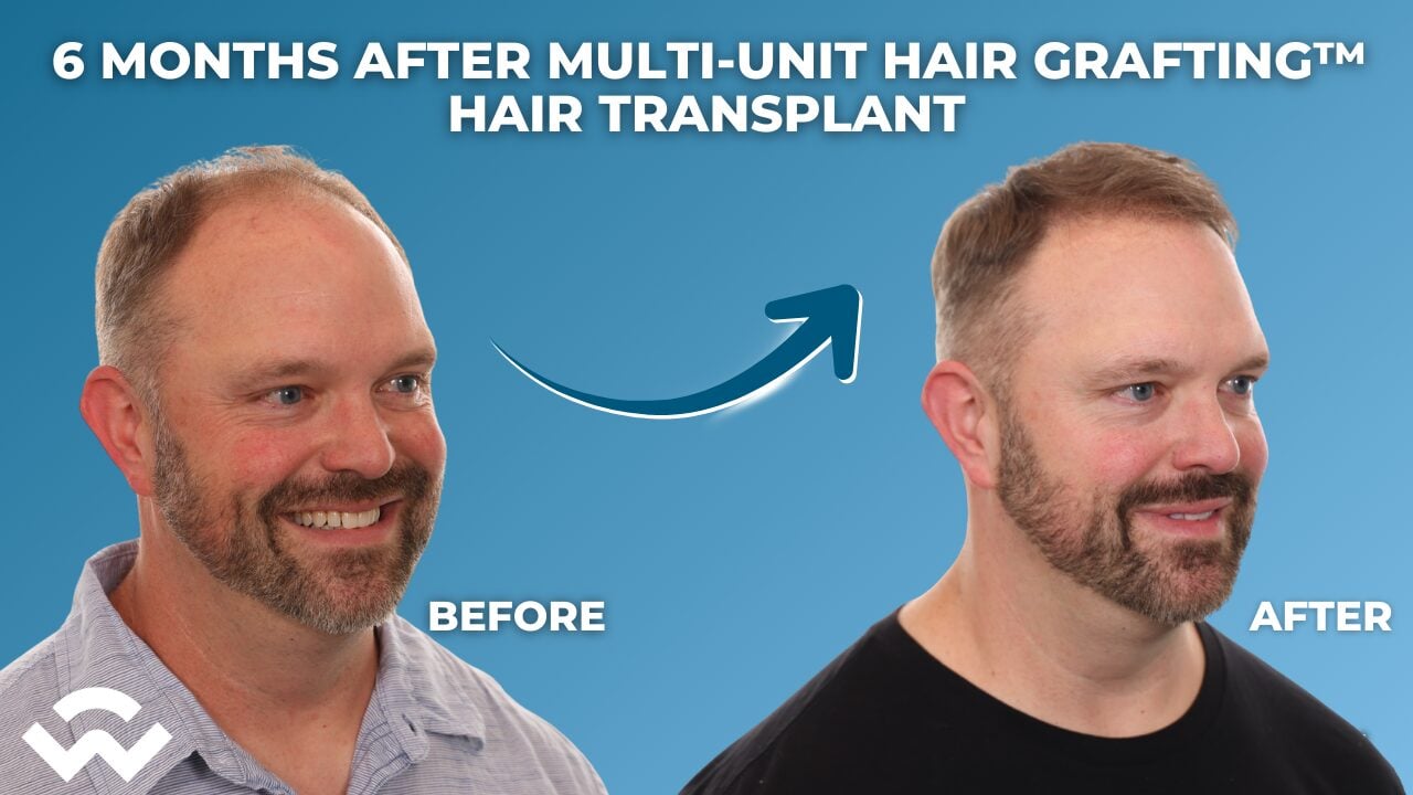 6 Months After Multi-Unit Hair Grafting&trade; Hair Transplant